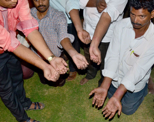 Swollen, reddened wrists and hands displayed after release from police custody Feb. 25 in Jaipur, Rajasthan, India.