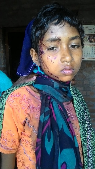 12-year-old Savitha Markhami was among those injured. (Photo: World Watch Monitor)