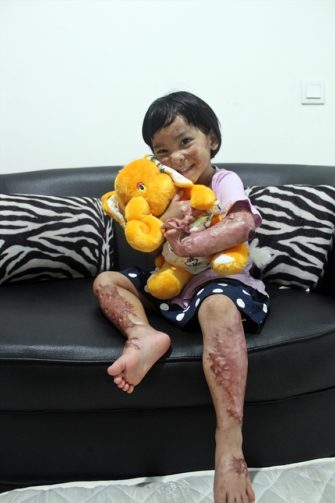 Four-year-old Trinity, one year after the attack, still needs treatment for burns she sustained. (Photo: World Watch Monitor)
