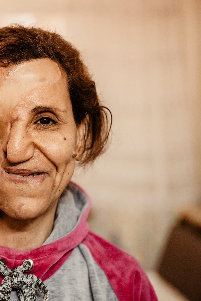 Samiha can neither hear, smell, nor see on the right side of her face. (World Watch Monitor)