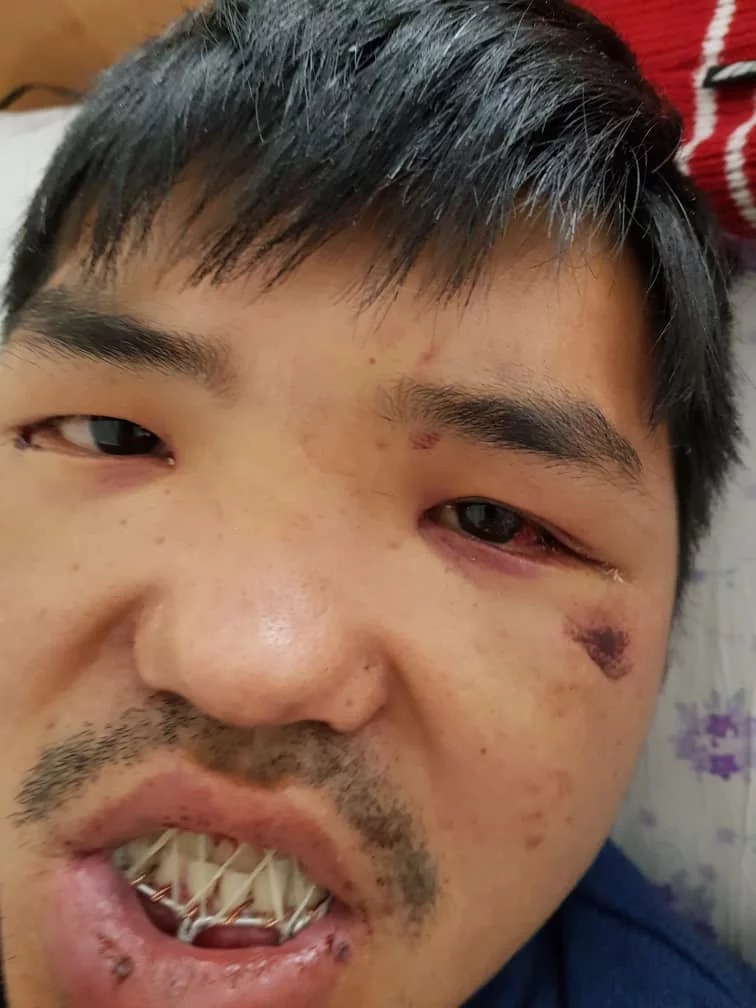 Sattar uuly was taken to the National Hospital in the Kyrgyz capital, Bishkek, where his jaw, gums and teeth were operated on. (World Watch Monitor)